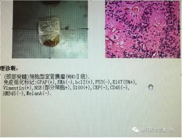 【病例】脊髓室管膜瘤1例MR影像表现 【病例】脊髓室管膜瘤1例MR影像表现