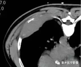 发生在肋骨上的15种肿瘤 发生在肋骨上的15种肿瘤