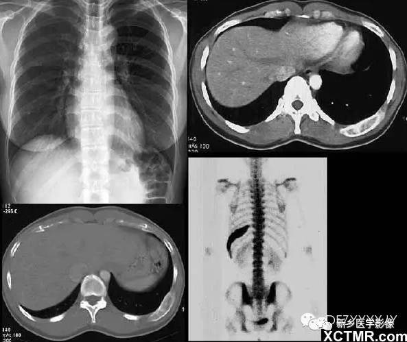 发生在肋骨上的15种肿瘤 发生在肋骨上的15种肿瘤