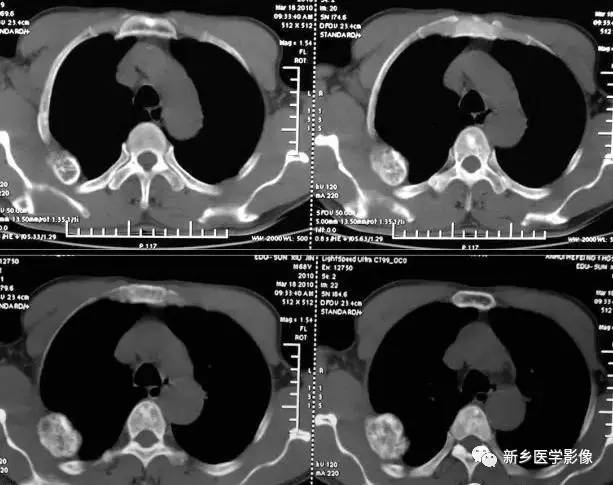 发生在肋骨上的15种肿瘤 发生在肋骨上的15种肿瘤