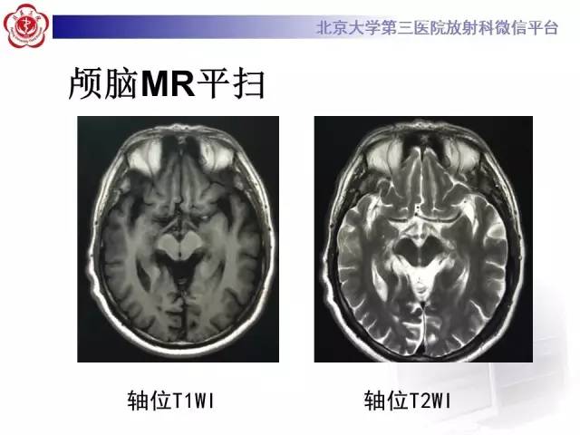 【病例】帕金森病1例MR影像表现