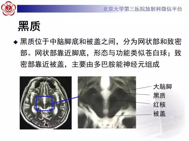 【病例】帕金森病1例MR影像表现