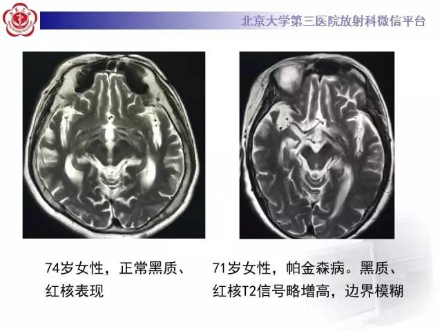 【病例】帕金森病1例MR影像表现