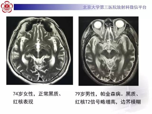 【病例】帕金森病1例MR影像表现