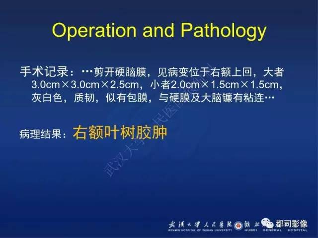 【PPT】颅内梅毒树胶肿影像诊断