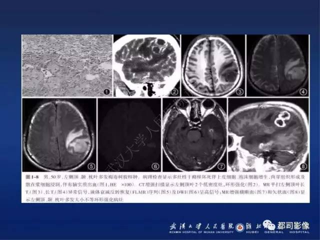 【PPT】颅内梅毒树胶肿影像诊断