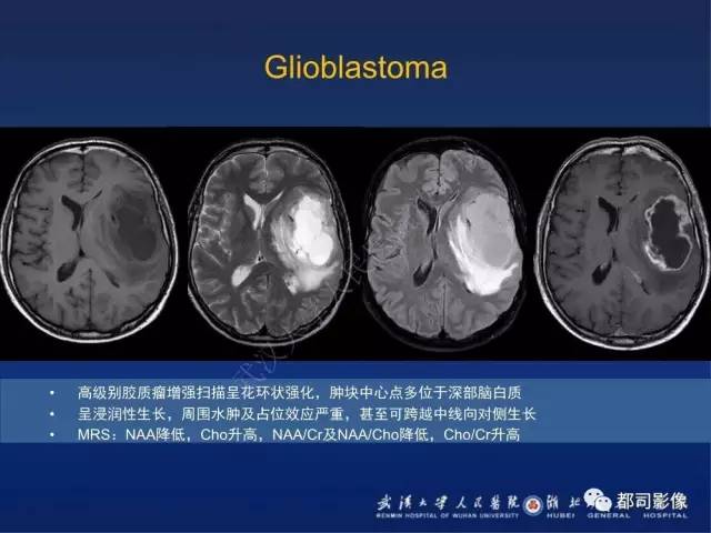 【PPT】颅内梅毒树胶肿影像诊断