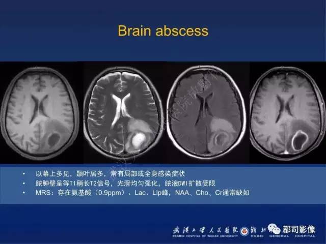 【PPT】颅内梅毒树胶肿影像诊断