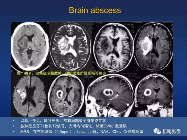 【PPT】颅内梅毒树胶肿影像诊断
