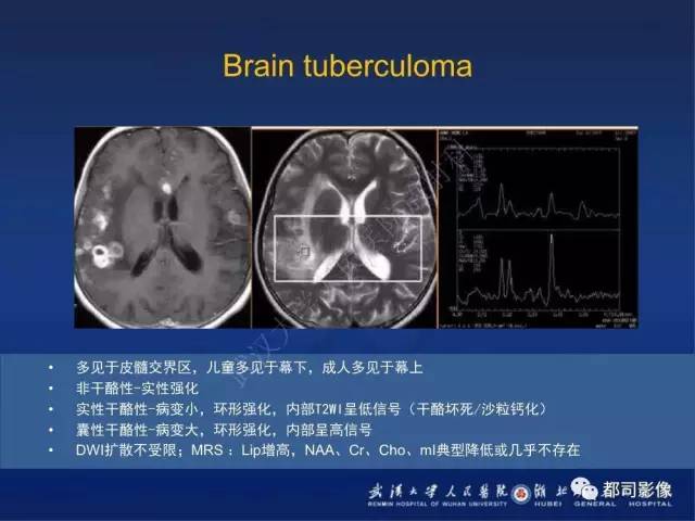【PPT】颅内梅毒树胶肿影像诊断