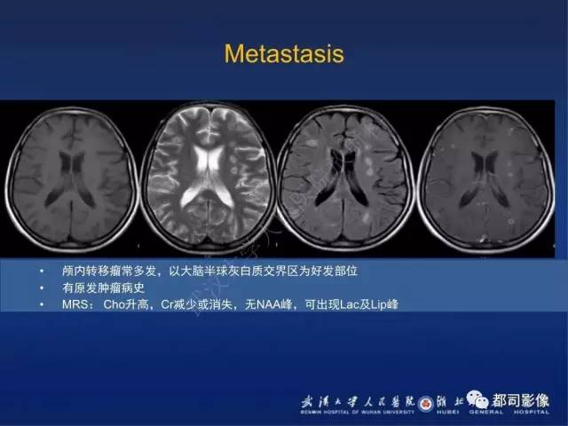 【PPT】颅内梅毒树胶肿影像诊断