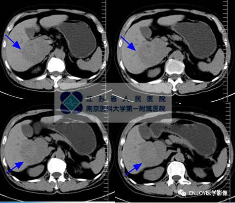 手把手教你会读片:典型肝癌影像诊断 手把手教你会读片:典型肝癌影像诊断