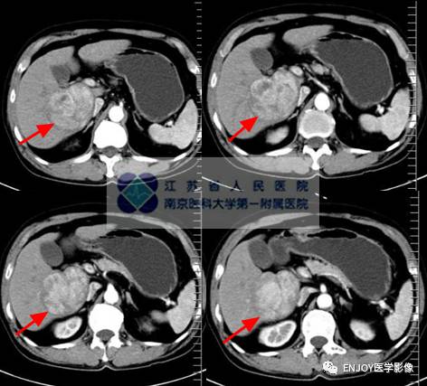 手把手教你会读片:典型肝癌影像诊断 手把手教你会读片:典型肝癌影像诊断