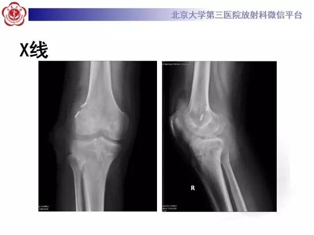 【病例】膝关节术后化脓性关节炎1例X线MR影像表现