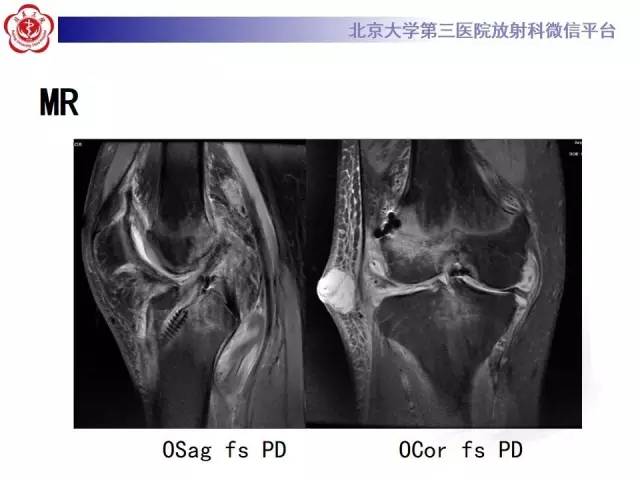 【病例】膝关节术后化脓性关节炎1例X线MR影像表现
