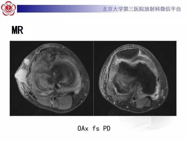 【病例】膝关节术后化脓性关节炎1例X线MR影像表现
