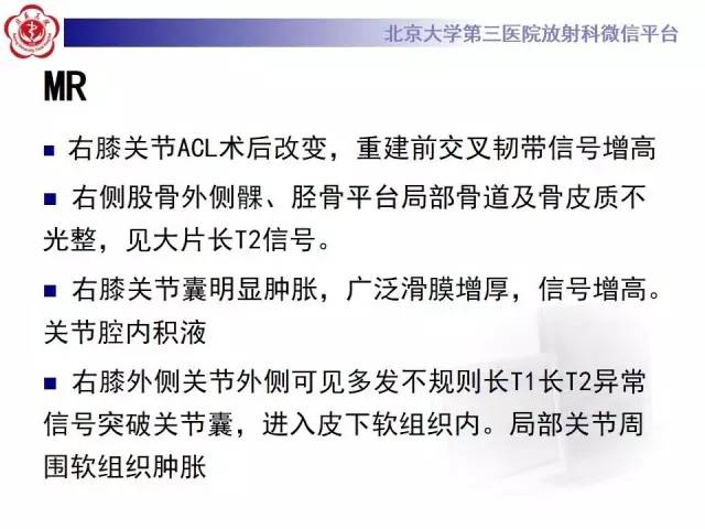 【病例】膝关节术后化脓性关节炎1例X线MR影像表现