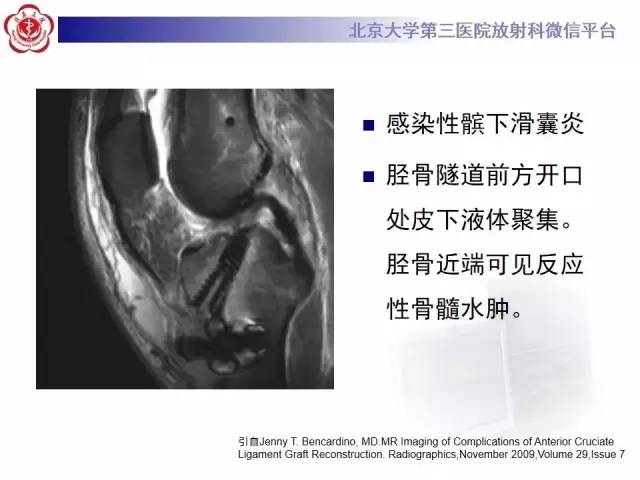 【病例】膝关节术后化脓性关节炎1例X线MR影像表现
