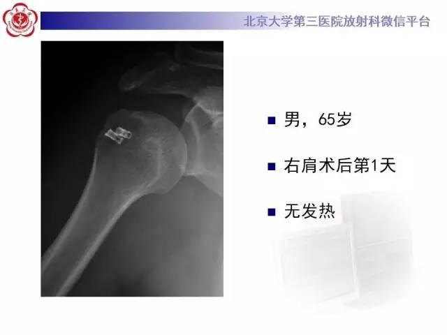【病例】膝关节术后化脓性关节炎1例X线MR影像表现