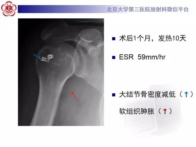 【病例】膝关节术后化脓性关节炎1例X线MR影像表现