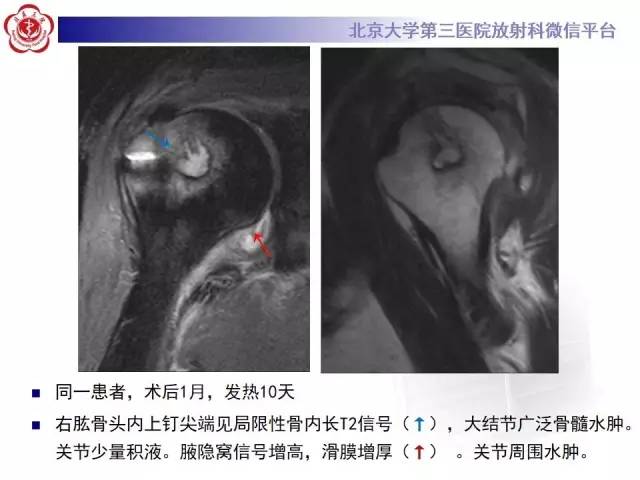 【病例】膝关节术后化脓性关节炎1例X线MR影像表现