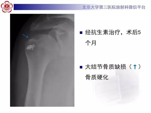 【病例】膝关节术后化脓性关节炎1例X线MR影像表现