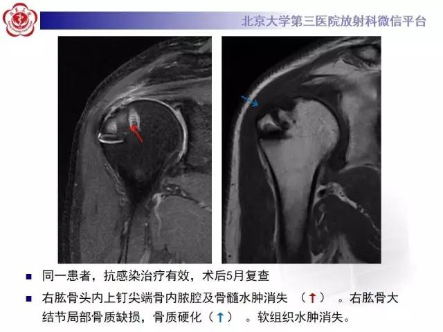 【病例】膝关节术后化脓性关节炎1例X线MR影像表现