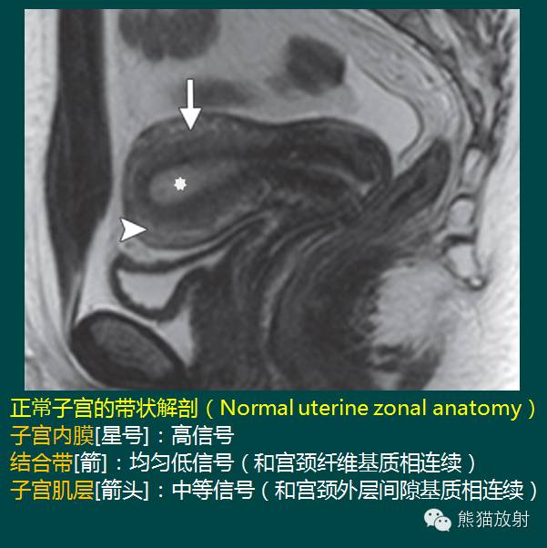 【PPT】子宫内膜癌及宫颈癌的MR扫描及评估【RG精选】 【PPT】子宫内膜癌及宫颈癌的MR扫描及评估【RG精选】