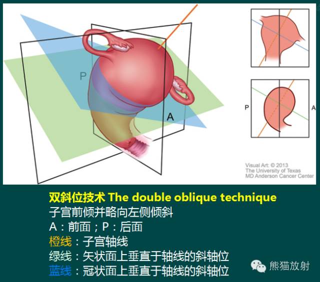 【PPT】子宫内膜癌及宫颈癌的MR扫描及评估【RG精选】 【PPT】子宫内膜癌及宫颈癌的MR扫描及评估【RG精选】