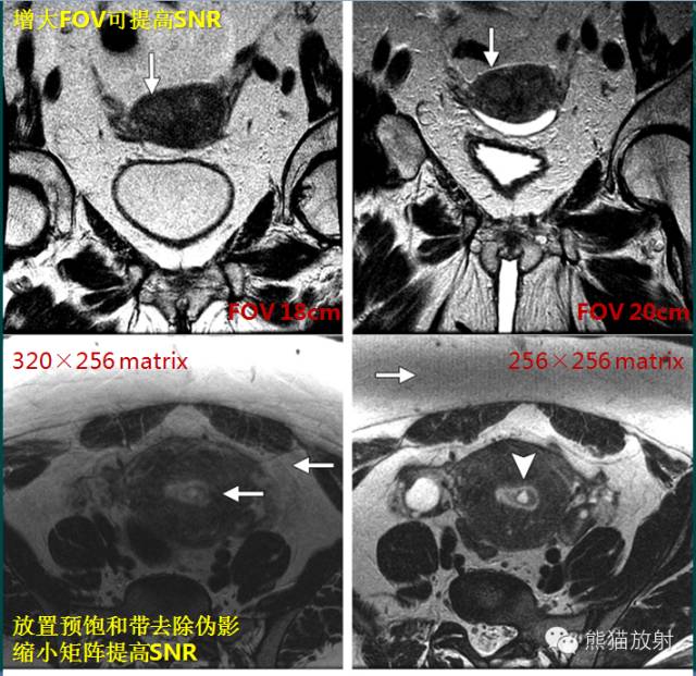 【PPT】子宫内膜癌及宫颈癌的MR扫描及评估【RG精选】 【PPT】子宫内膜癌及宫颈癌的MR扫描及评估【RG精选】