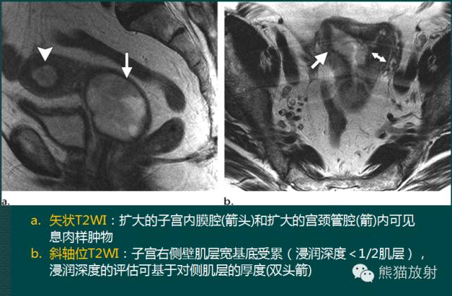 【PPT】子宫内膜癌及宫颈癌的MR扫描及评估【RG精选】 【PPT】子宫内膜癌及宫颈癌的MR扫描及评估【RG精选】