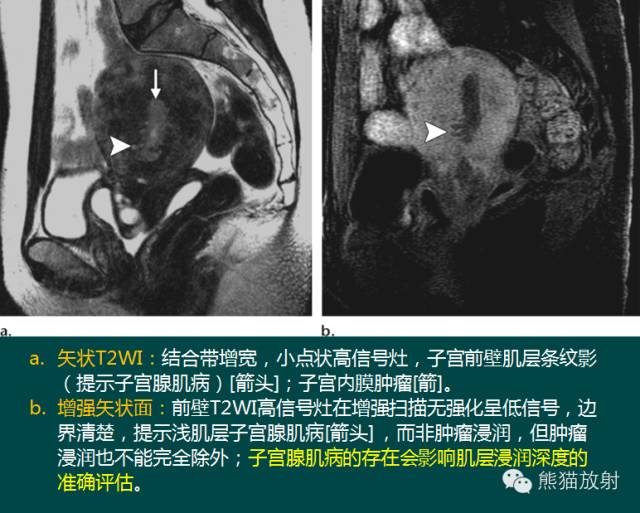 【PPT】子宫内膜癌及宫颈癌的MR扫描及评估【RG精选】 【PPT】子宫内膜癌及宫颈癌的MR扫描及评估【RG精选】