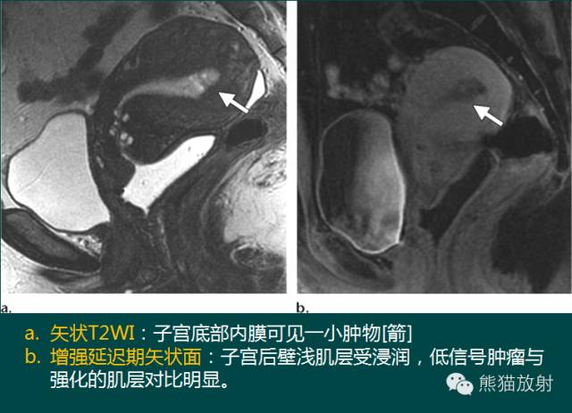 【PPT】子宫内膜癌及宫颈癌的MR扫描及评估【RG精选】 【PPT】子宫内膜癌及宫颈癌的MR扫描及评估【RG精选】