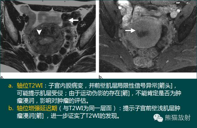 【PPT】子宫内膜癌及宫颈癌的MR扫描及评估【RG精选】 【PPT】子宫内膜癌及宫颈癌的MR扫描及评估【RG精选】