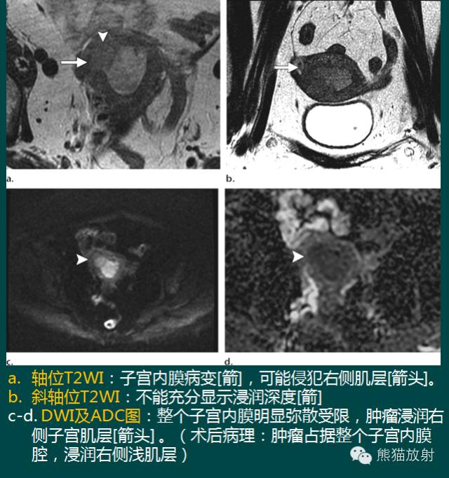 【PPT】子宫内膜癌及宫颈癌的MR扫描及评估【RG精选】 【PPT】子宫内膜癌及宫颈癌的MR扫描及评估【RG精选】