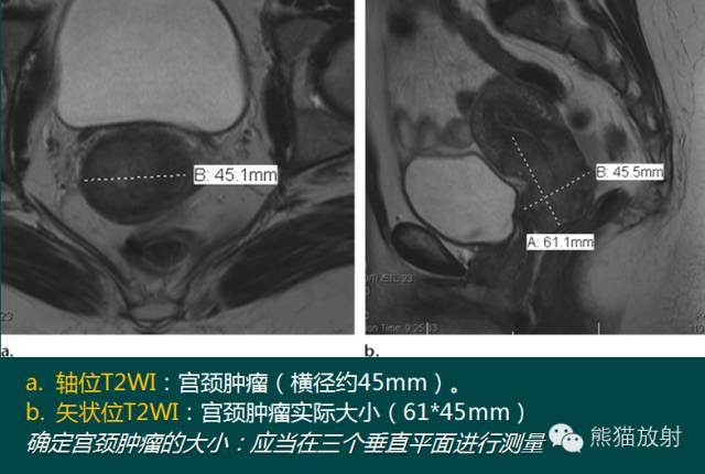 【PPT】子宫内膜癌及宫颈癌的MR扫描及评估【RG精选】 【PPT】子宫内膜癌及宫颈癌的MR扫描及评估【RG精选】