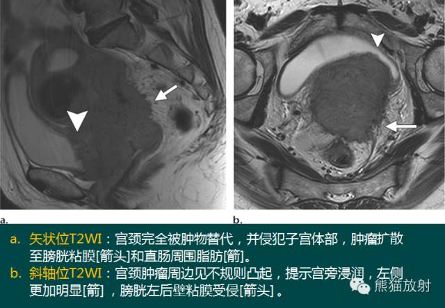 【PPT】子宫内膜癌及宫颈癌的MR扫描及评估【RG精选】 【PPT】子宫内膜癌及宫颈癌的MR扫描及评估【RG精选】