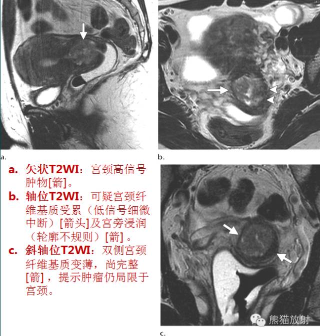 【PPT】子宫内膜癌及宫颈癌的MR扫描及评估【RG精选】 【PPT】子宫内膜癌及宫颈癌的MR扫描及评估【RG精选】