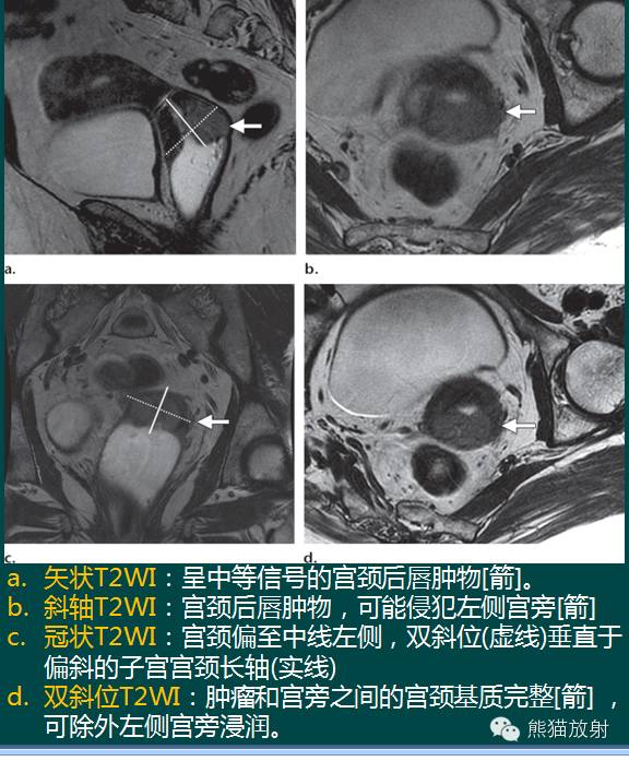 【PPT】子宫内膜癌及宫颈癌的MR扫描及评估【RG精选】 【PPT】子宫内膜癌及宫颈癌的MR扫描及评估【RG精选】