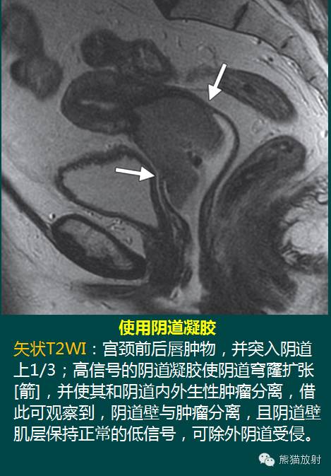 【PPT】子宫内膜癌及宫颈癌的MR扫描及评估【RG精选】 【PPT】子宫内膜癌及宫颈癌的MR扫描及评估【RG精选】