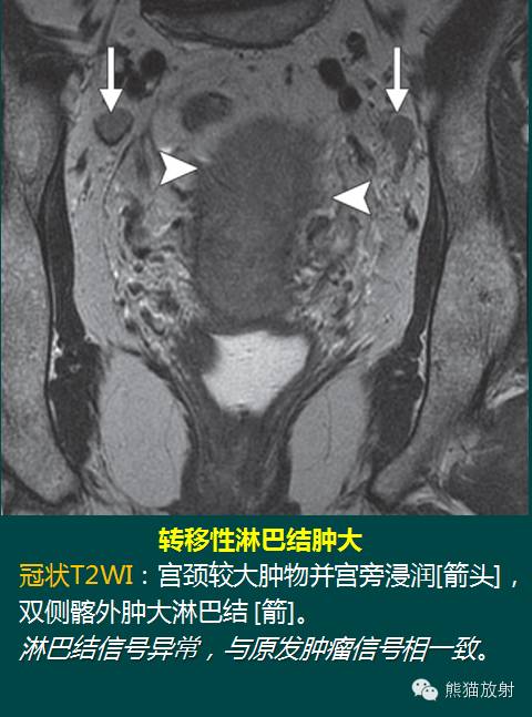 【PPT】子宫内膜癌及宫颈癌的MR扫描及评估【RG精选】 【PPT】子宫内膜癌及宫颈癌的MR扫描及评估【RG精选】