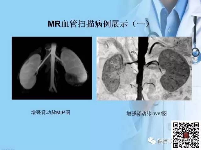 【PPT】磁共振血管成像技术的应用
