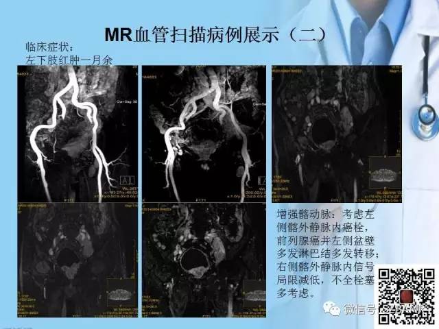 【PPT】磁共振血管成像技术的应用