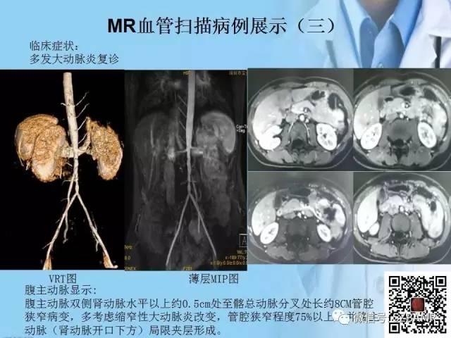 【PPT】磁共振血管成像技术的应用