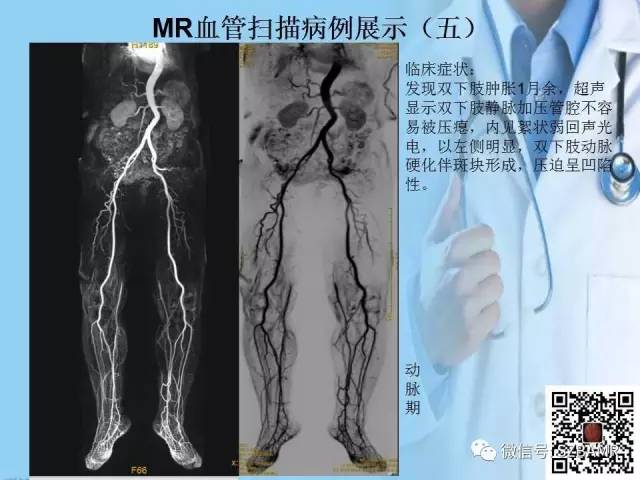 【PPT】磁共振血管成像技术的应用