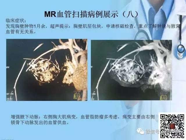 【PPT】磁共振血管成像技术的应用