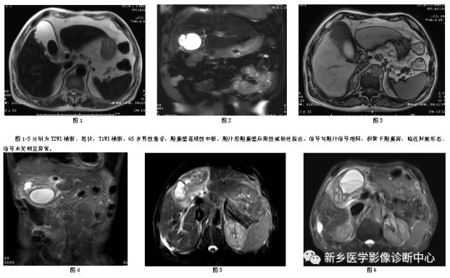 影像诊断中，您会诊断胆囊穿孔吗?