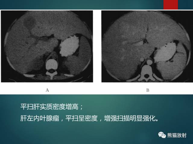 【PPT】肝糖原累积症(弥漫性肝实质密度增高病变的鉴别诊断)