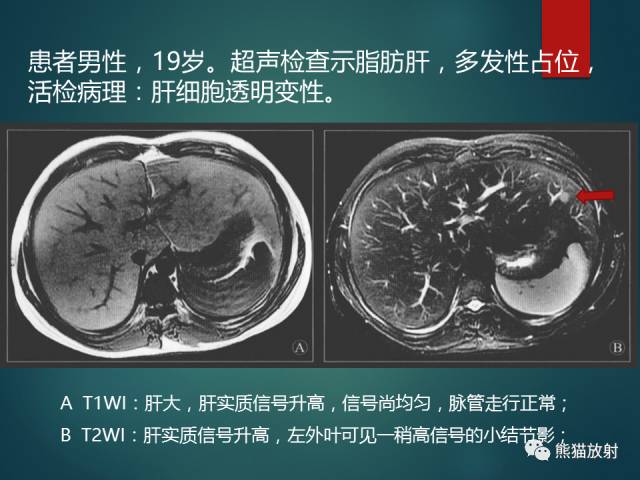 【PPT】肝糖原累积症(弥漫性肝实质密度增高病变的鉴别诊断)