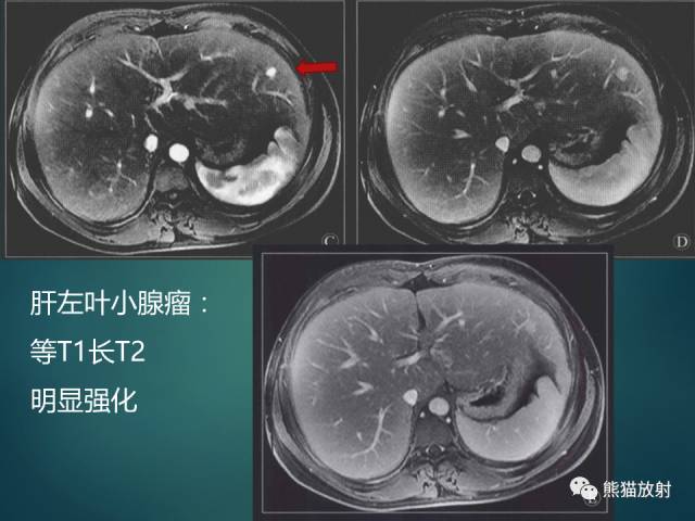 【PPT】肝糖原累积症(弥漫性肝实质密度增高病变的鉴别诊断)